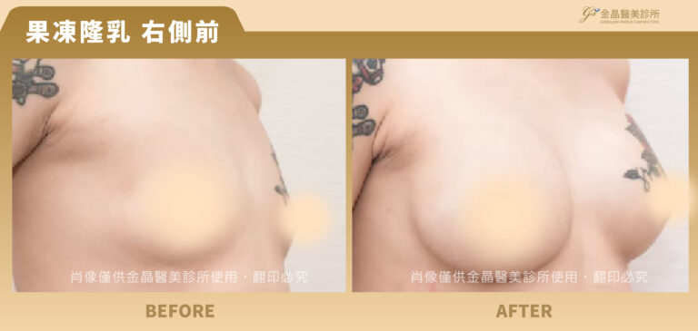 240112-肖像框-果凍隆乳-Jing_果凍1-4