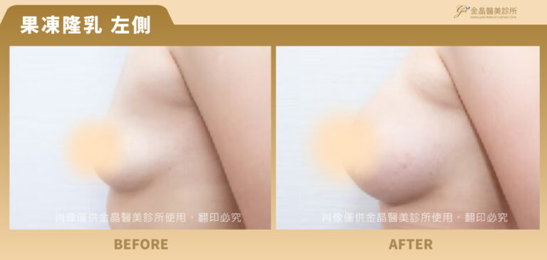 240112-肖像框-果凍隆乳-Jing_果凍4-3