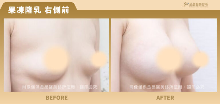 240112-肖像框-果凍隆乳-Jing_果凍6-2