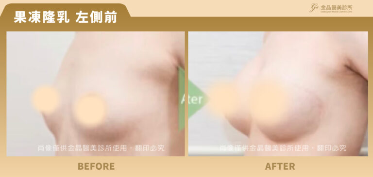 240112-肖像框-果凍隆乳-Jing_果凍9-2